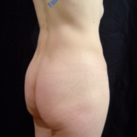 Gluteal Augmentation with implants, case 3 – Before