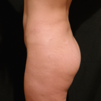 Gluteal Augmentation with implants, case 5 – After