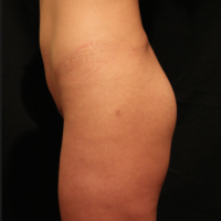 Gluteal Augmentation with implants, case 5 – Before