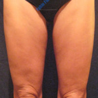 Inner thigh lift including liposuction, case 2 – After