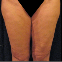 Inner thigh lift including liposuction, case 3 – After
