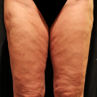 Inner thigh lift including liposuction, case 3 – Before