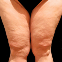 Inner thigh lift including liposuction, case 4 – After
