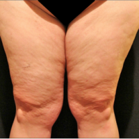 Inner thigh lift including liposuction, case 4 – Before