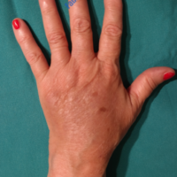 Lipo-Filling hands – Case 1 – After
