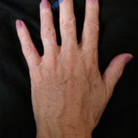 Lipo-Filling hands – Case 2a – After