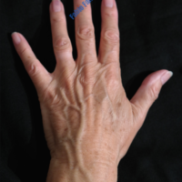 Lipo-Filling hands – Case 2a – Before