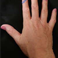 Lipo-Filling hands – Case 2b – After