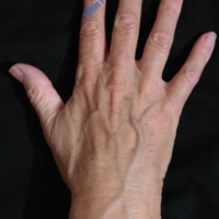 Lipo-Filling hands – Case 2b – Before