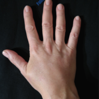 Lipo-Filling hands – Case 3a – After