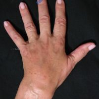 Lipo-Filling hands – Case 4b – After