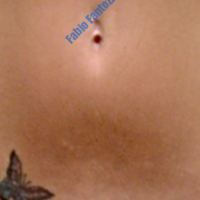Lipo-grafting case 7- Navel piercing damage treated with lipofiling – Before