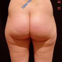 Liposuction & Lipo-filling case 1- Perigluteal – Before
