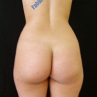 Liposuction & Lipo-filling case 6- Perigluteal – Before