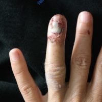 Reconstruction of finger – Case 11 – Before