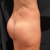 Gluteal Augmentation with implants, case 4 Lateral View – After
